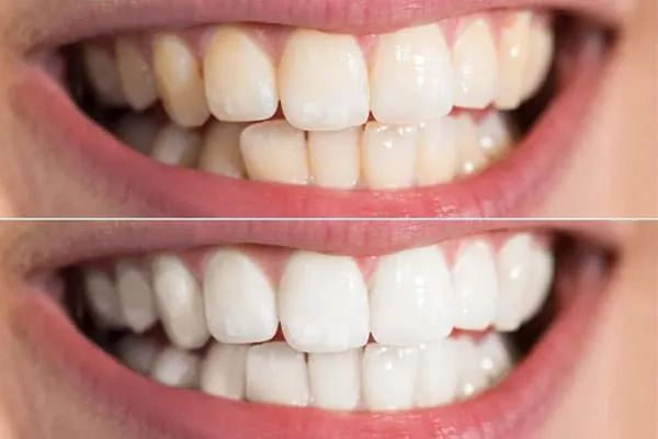 Best Dental Clinic in Madurai - Dentes Clinic