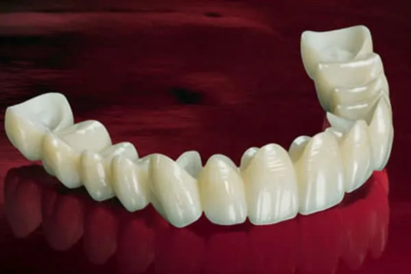 Teeth Whitening in Madurai - Dentes Clinic