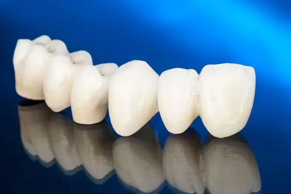 Dental Implants in Madurai - Dentes Clinic