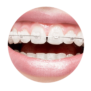 clear-braces-rounded