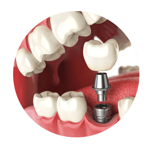 dental-implants-rounded
