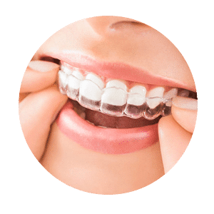 invisible-braces-rounded