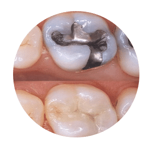 restoration-(fillings)-rounded