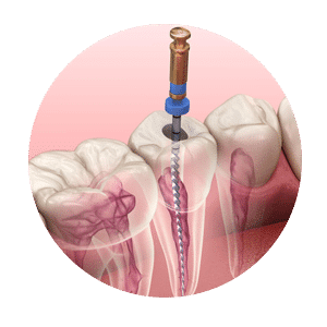 root-canal-treatment-rounded