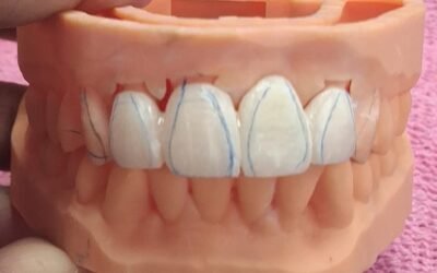  Front Tooth Lost… Full Smile Restored: A Complete Bridge Transformation at Dentes Clinic, Madurai